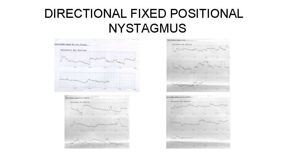 DIRECTIONAL FIXED POSITIONAL NYSTAGMUS 