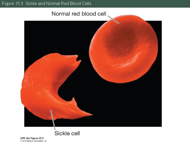 Figure 15. 3 Sickle and Normal Red Blood Cells 