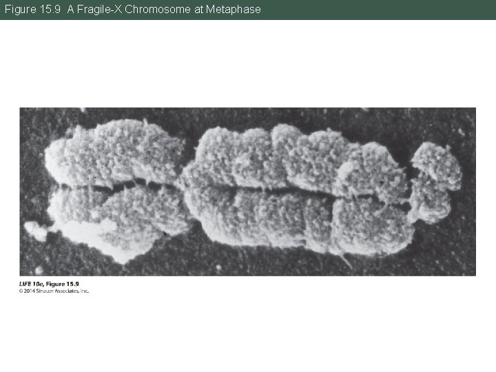 Figure 15. 9 A Fragile-X Chromosome at Metaphase 