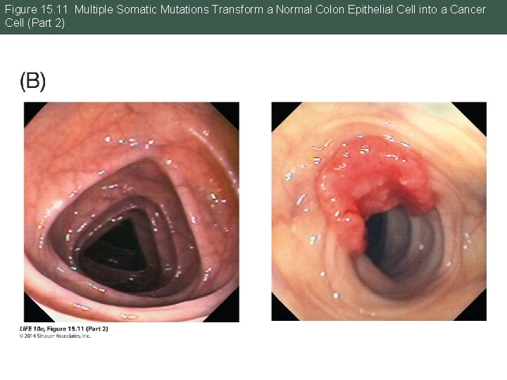Figure 15. 11 Multiple Somatic Mutations Transform a Normal Colon Epithelial Cell into a