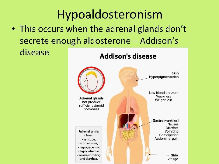 Hypoaldosteronism • This occurs when the adrenal glands don’t secrete enough aldosterone – Addison’s