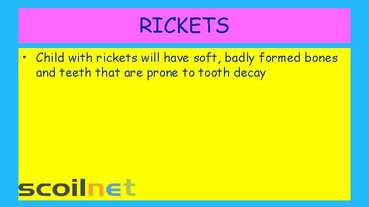 RICKETS • Child with rickets will have soft, badly formed bones and teeth that
