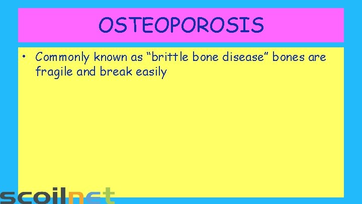 OSTEOPOROSIS • Commonly known as “brittle bone disease” bones are fragile and break easily