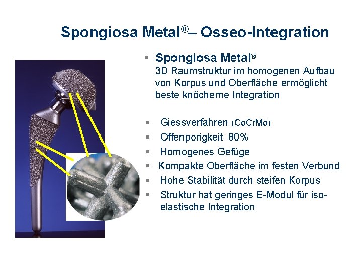 Spongiosa Metal®– Osseo-Integration § Spongiosa Metal® 3 D Raumstruktur im homogenen Aufbau von Korpus