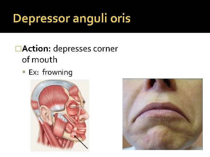 Depressor anguli oris �Action: depresses corner of mouth Ex: frowning 