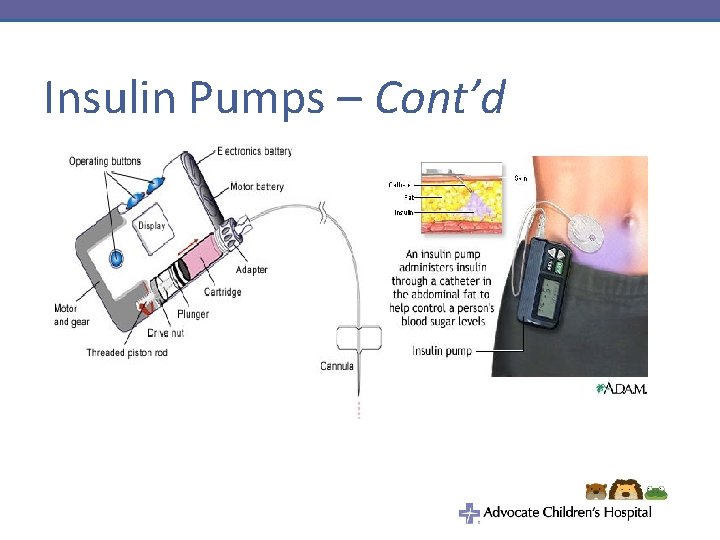Insulin Pumps – Cont’d 