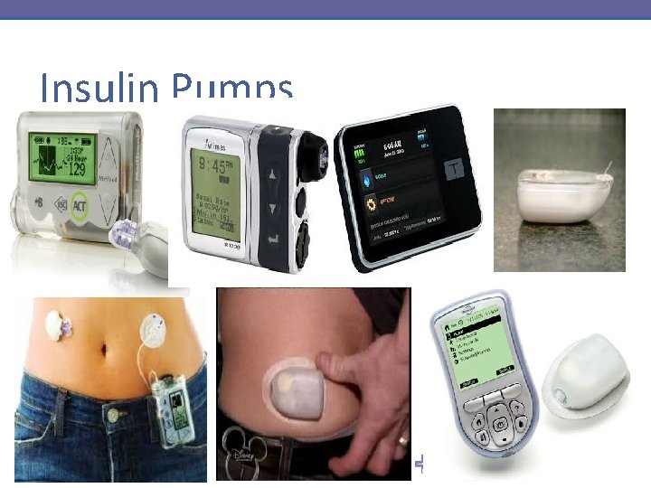 Insulin Pumps 