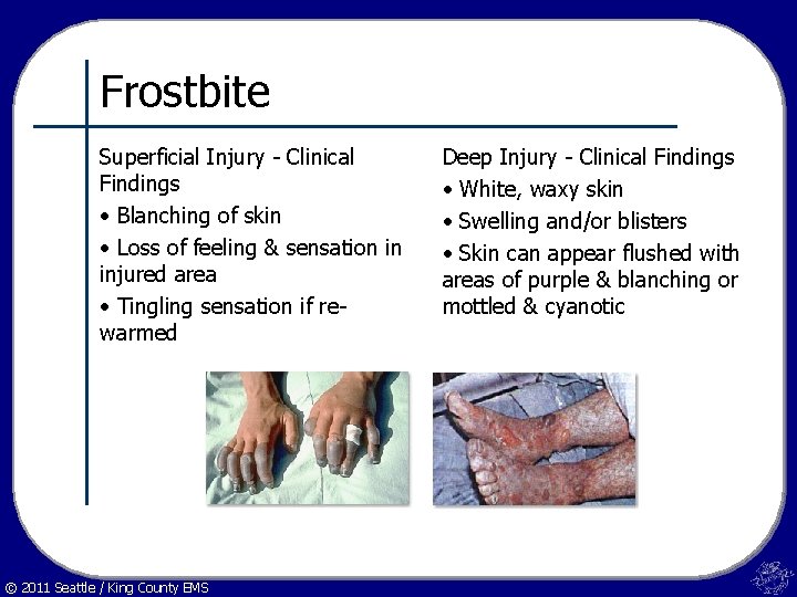 Frostbite Superficial Injury - Clinical Findings • Blanching of skin • Loss of feeling