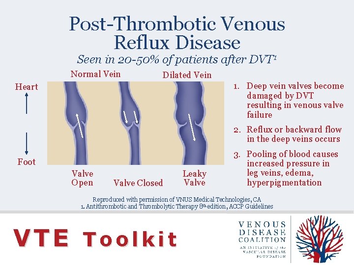 Post-Thrombotic Venous Reflux Disease Seen in 20 -50% of patients after DVT 1 Normal