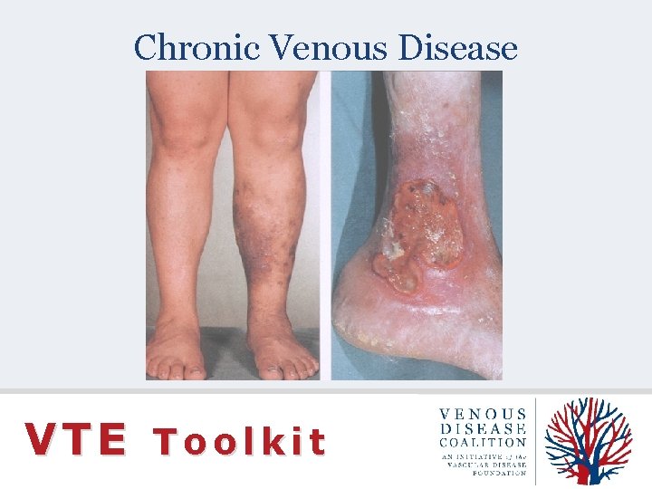 Chronic Venous Disease VTE Toolkit 