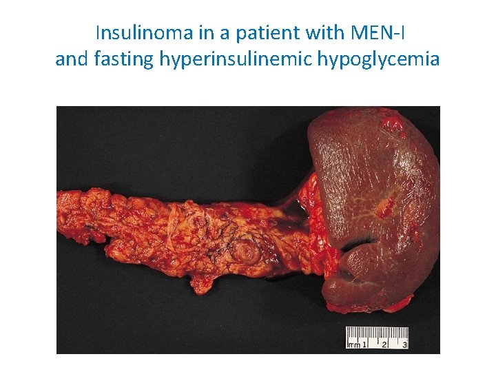 Insulinoma in a patient with MEN-I and fasting hyperinsulinemic hypoglycemia 