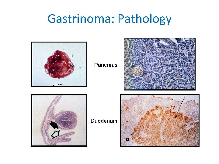 Gastrinoma: Pathology Pancreas 2 -3 cm Duodenum 