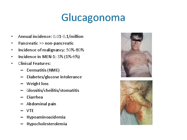 Glucagonoma • • • Annual incidence: 0. 01 -0. 1/million Pancreatic >> non-pancreatic Incidence