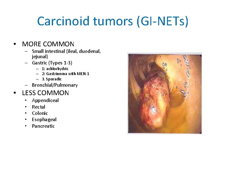 Carcinoid tumors (GI-NETs) • MORE COMMON – Small intestinal (ileal, duodenal, jejunal) – Gastric