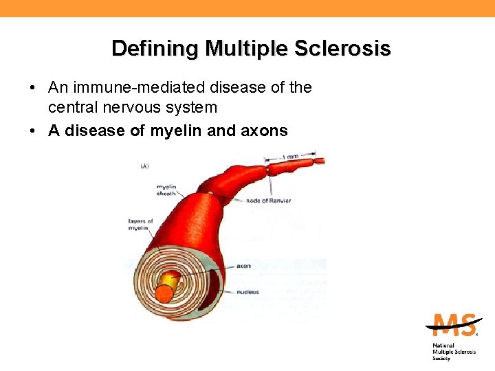 Defining Multiple Sclerosis • An immune-mediated disease of the central nervous system • A