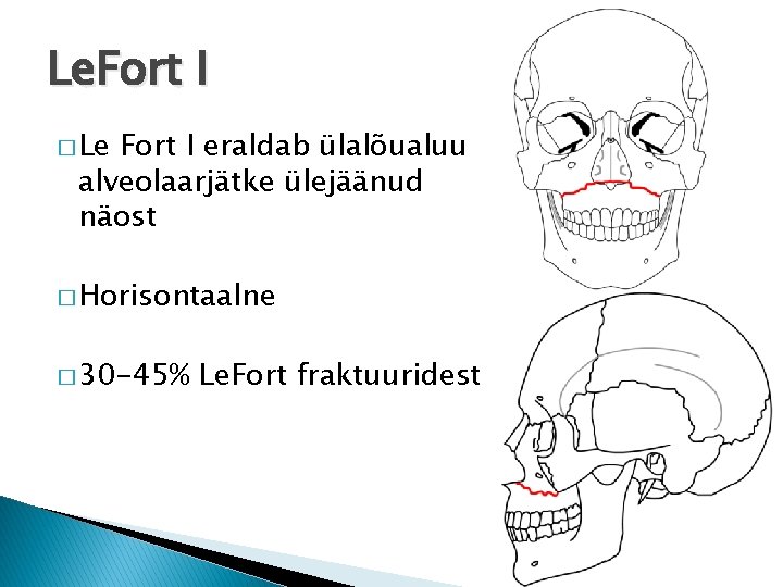 Le. Fort I � Le Fort I eraldab ülalõualuu alveolaarjätke ülejäänud näost � Horisontaalne