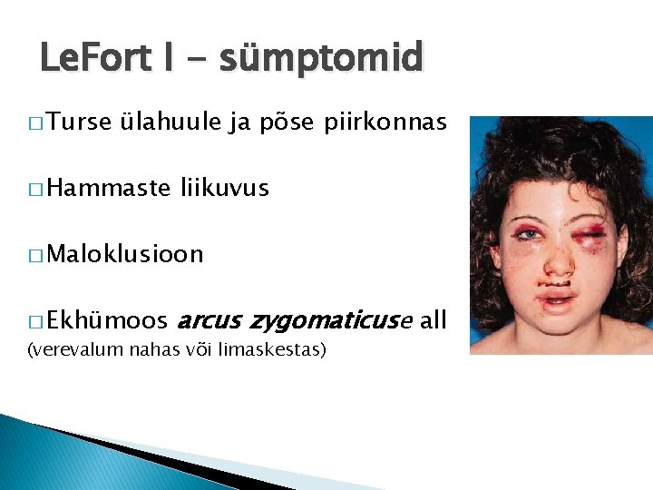 Le. Fort I - sümptomid � Turse ülahuule ja põse piirkonnas � Hammaste liikuvus