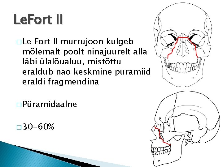 Le. Fort II � Le Fort II murrujoon kulgeb mõlemalt poolt ninajuurelt alla läbi