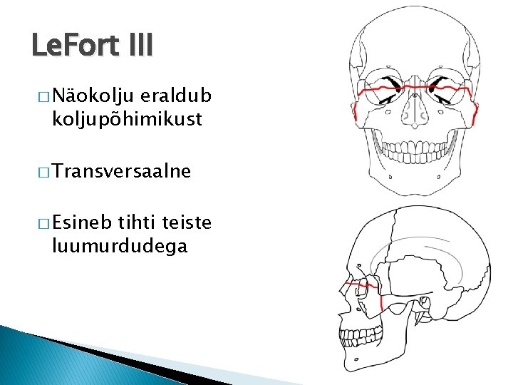 Le. Fort III � Näokolju eraldub koljupõhimikust � Transversaalne � Esineb tihti teiste luumurdudega