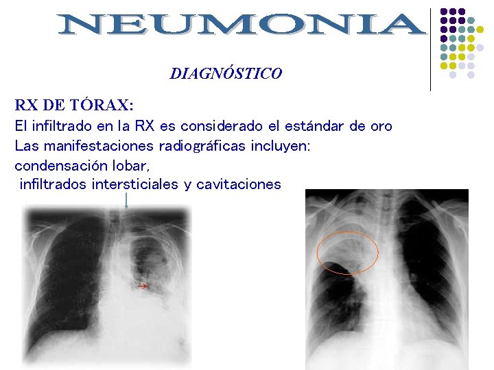 DIAGNÓSTICO RX DE TÓRAX: El infiltrado en la RX es considerado el estándar de