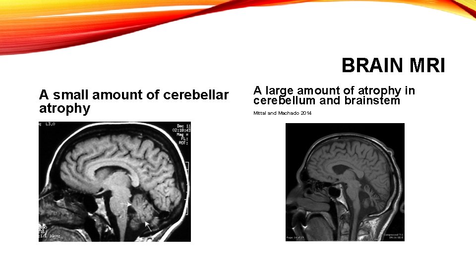BRAIN MRI A small amount of cerebellar atrophy A large amount of atrophy in BRAIN MRI A small amount of cerebellar atrophy A large amount of atrophy in