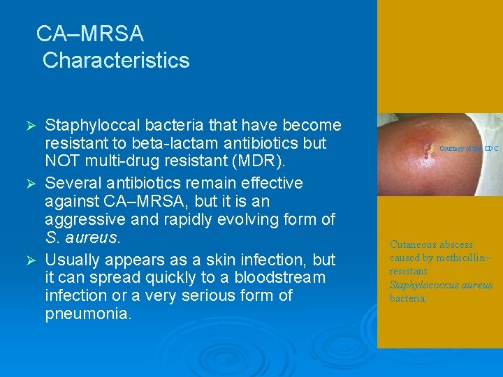 CA–MRSA Characteristics Staphyloccal bacteria that have become resistant to beta-lactam antibiotics but NOT multi-drug