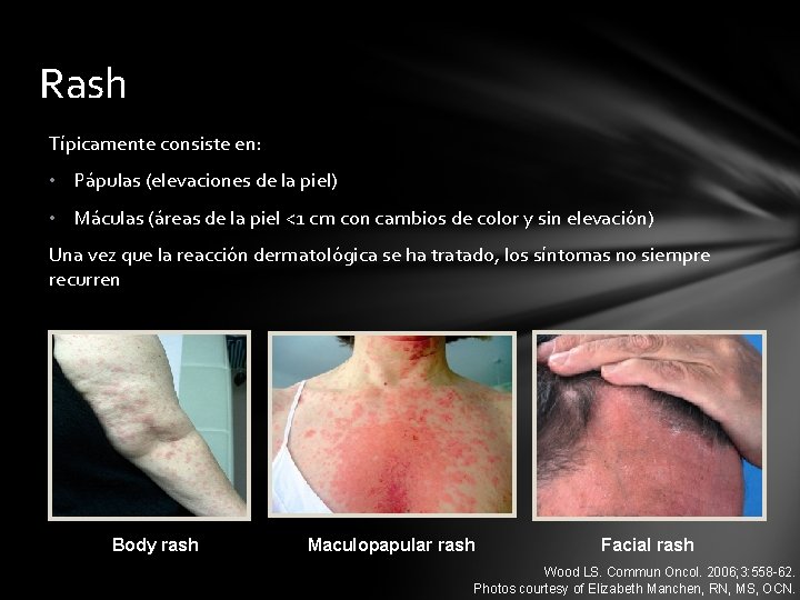 Rash Típicamente consiste en: • Pápulas (elevaciones de la piel) • Máculas (áreas de