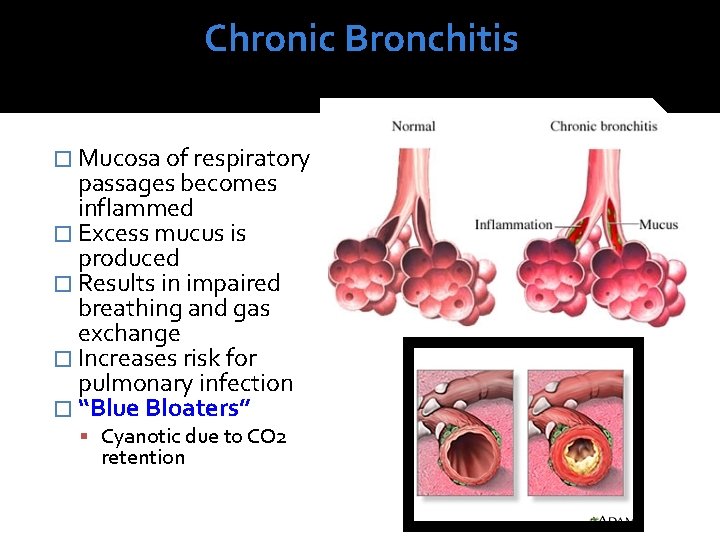 Chronic Bronchitis � Mucosa of respiratory passages becomes inflammed � Excess mucus is produced