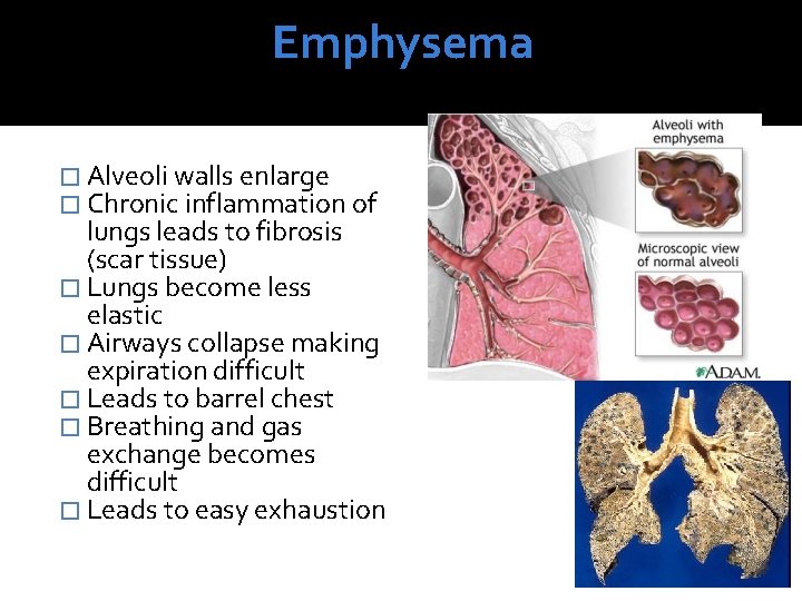 Emphysema � Alveoli walls enlarge � Chronic inflammation of lungs leads to fibrosis (scar