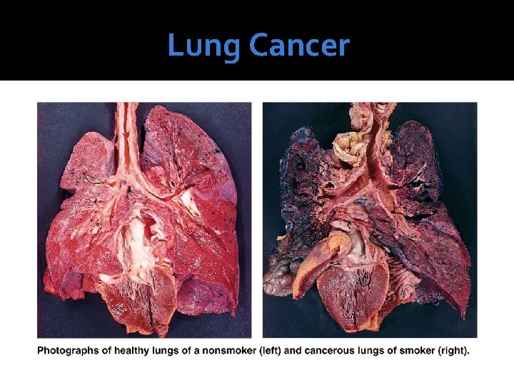 Lung Cancer 