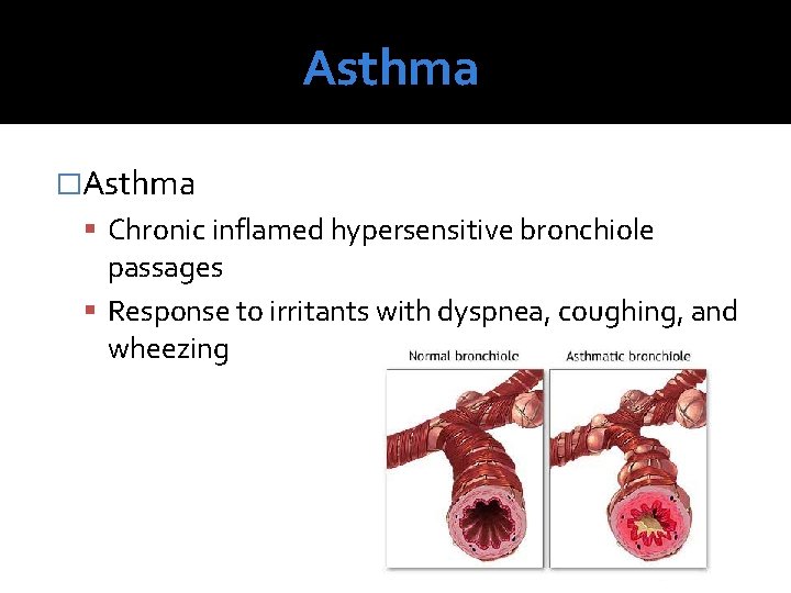 Asthma �Asthma Chronic inflamed hypersensitive bronchiole passages Response to irritants with dyspnea, coughing, and