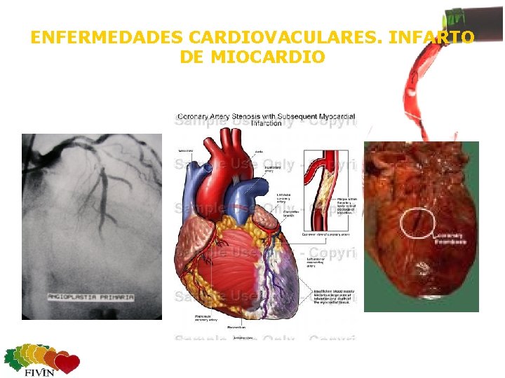 ENFERMEDADES CARDIOVACULARES. INFARTO DE MIOCARDIO 