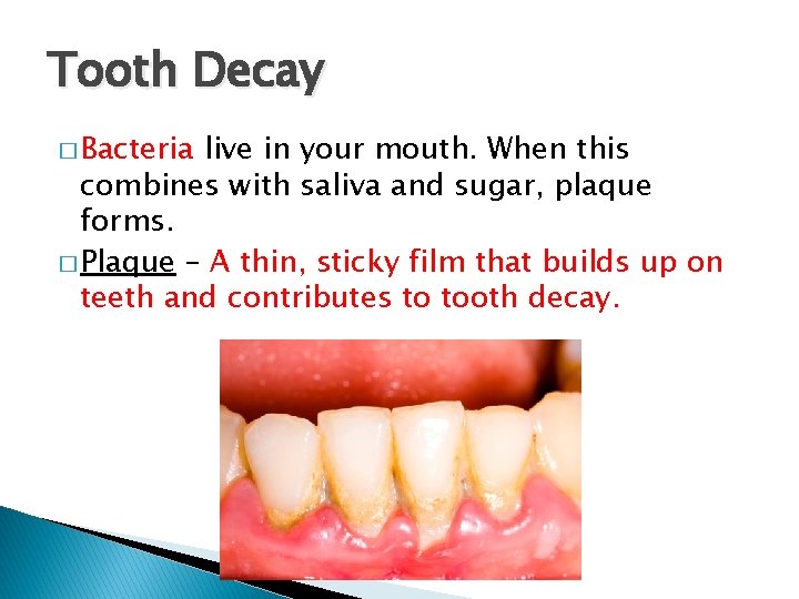 Tooth Decay � Bacteria live in your mouth. When this combines with saliva and