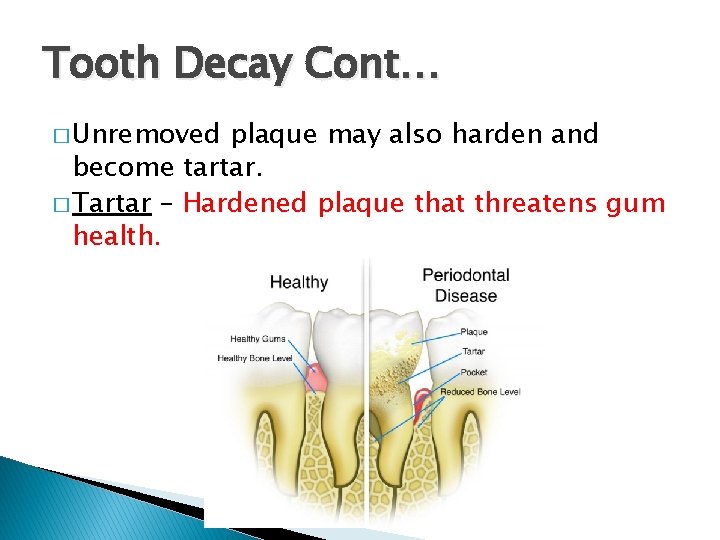 Tooth Decay Cont… � Unremoved plaque may also harden and become tartar. � Tartar