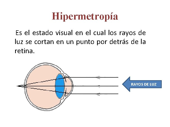 Hipermetropía Es el estado visual en el cual los rayos de luz se cortan