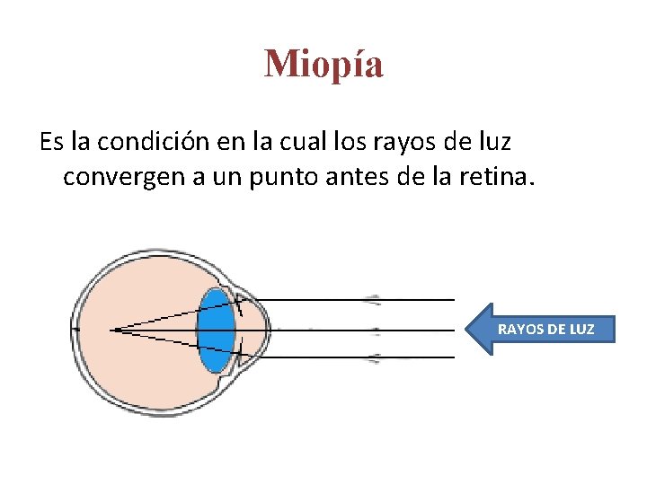 Miopía Es la condición en la cual los rayos de luz convergen a un