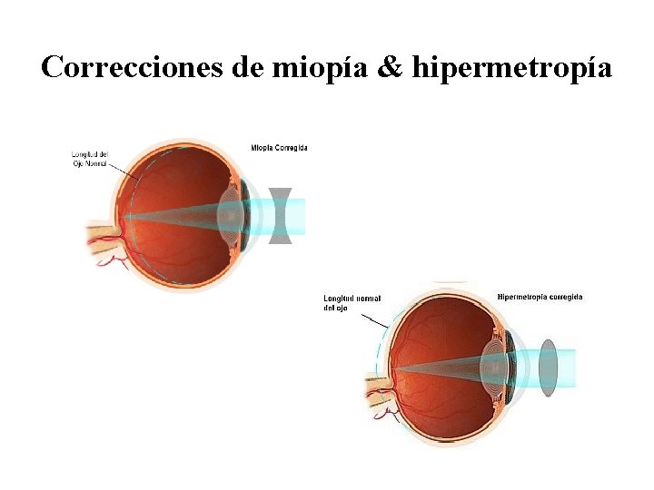 Correcciones de miopía & hipermetropía 