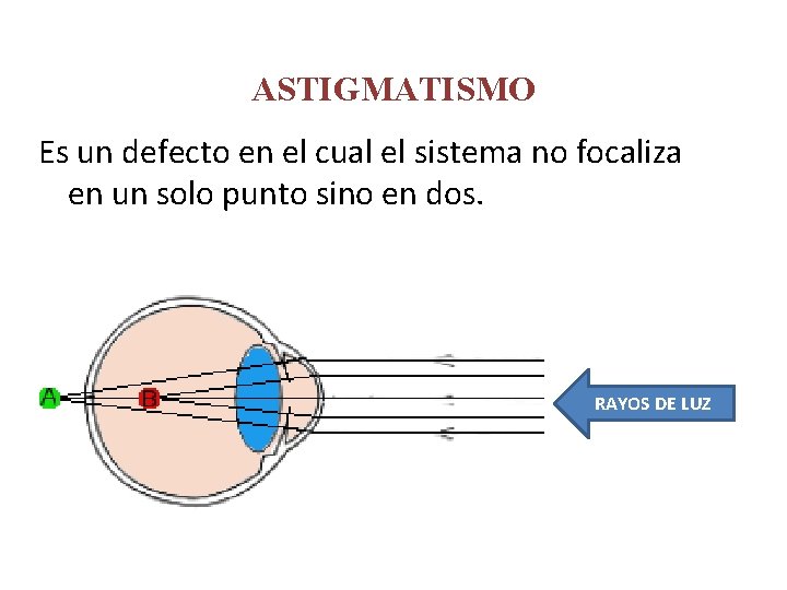 ASTIGMATISMO Es un defecto en el cual el sistema no focaliza en un solo