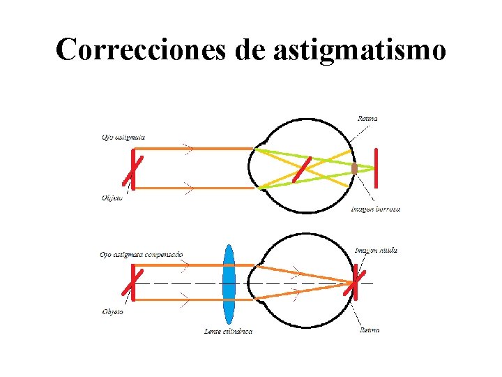 Correcciones de astigmatismo 