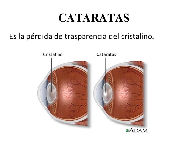 CATARATAS Es la pérdida de trasparencia del cristalino. 