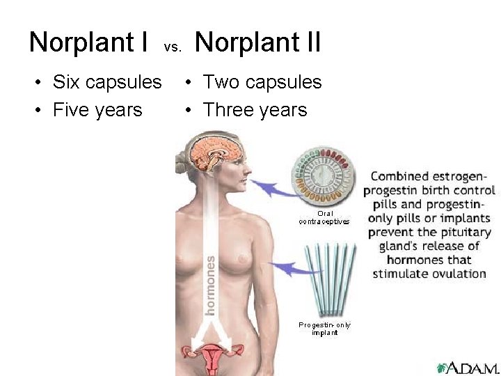 Norplant I vs. Norplant II • Six capsules • Five years • Two capsules