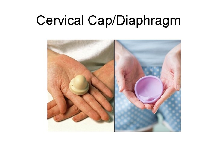 Cervical Cap/Diaphragm 