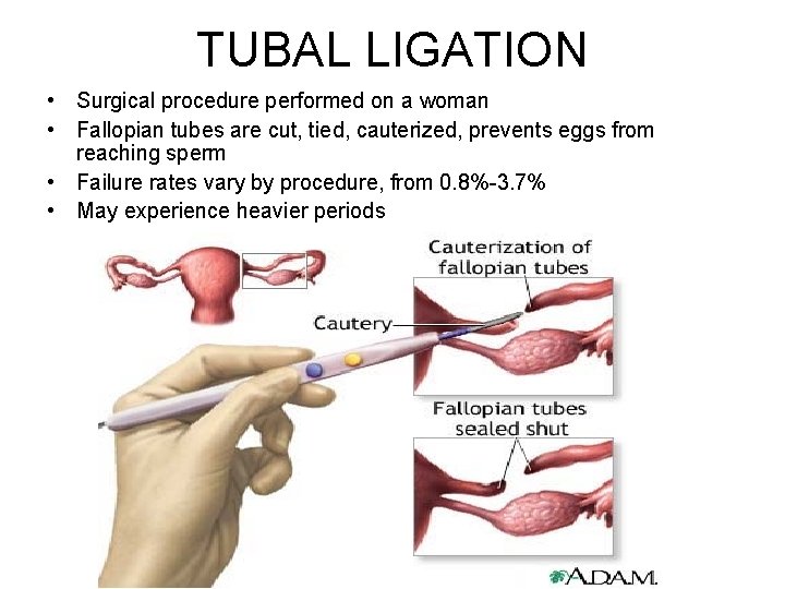 TUBAL LIGATION • Surgical procedure performed on a woman • Fallopian tubes are cut,