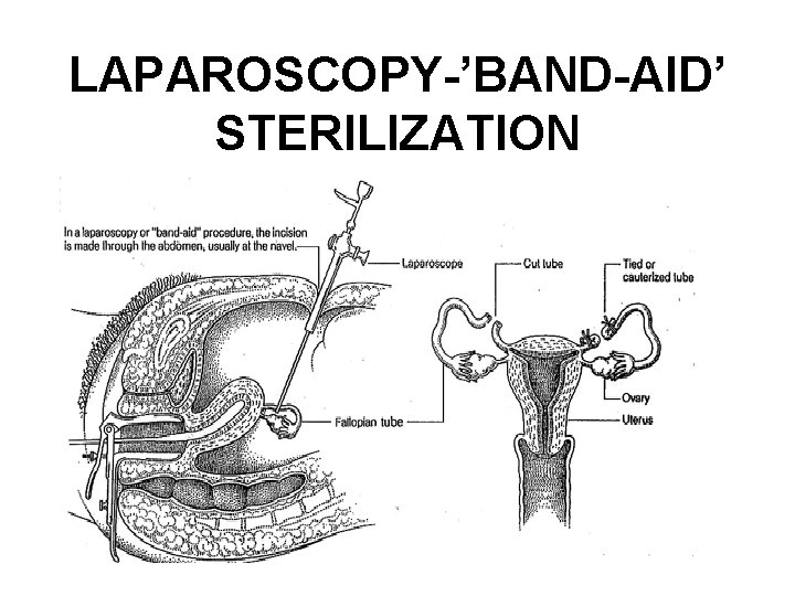 LAPAROSCOPY-’BAND-AID’ STERILIZATION 