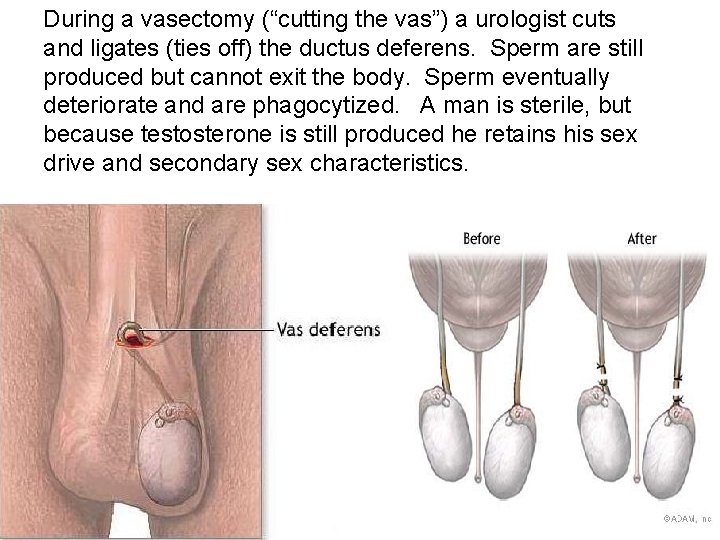During a vasectomy (“cutting the vas”) a urologist cuts and ligates (ties off) the