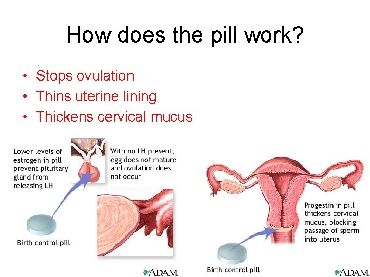 How does the pill work? • Stops ovulation • Thins uterine lining • Thickens