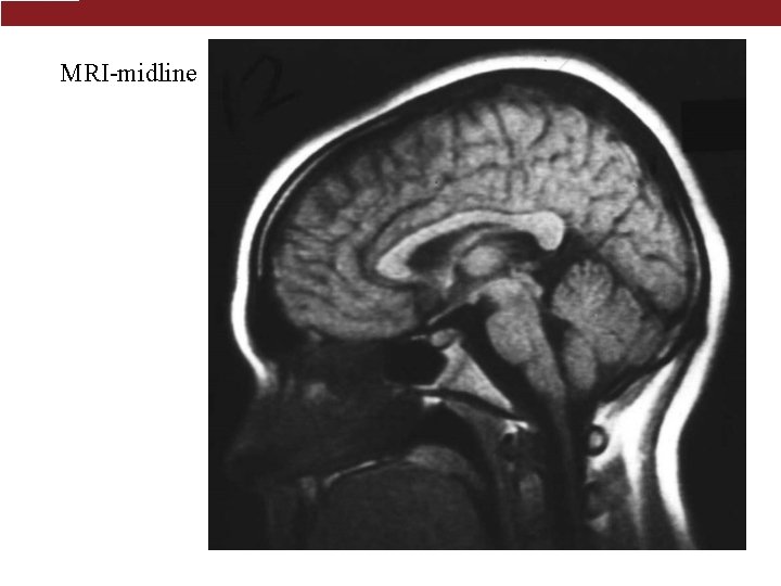 MRI-midline 