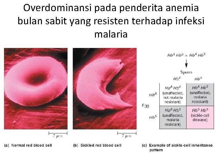 Overdominansi pada penderita anemia bulan sabit yang resisten terhadap infeksi malaria 