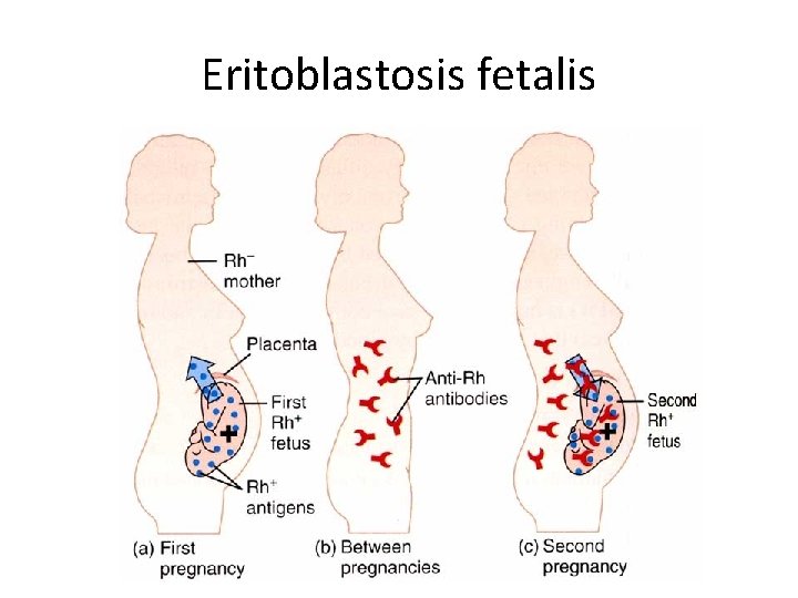 Eritoblastosis fetalis 