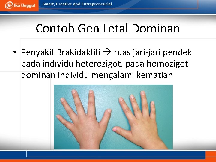 Contoh Gen Letal Dominan • Penyakit Brakidaktili ruas jari-jari pendek pada individu heterozigot, pada